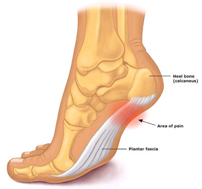 Foot pain – Plantar Fasciitis